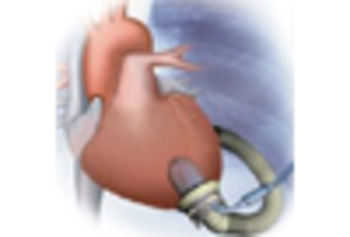 US Heart Pump Devices Market key player